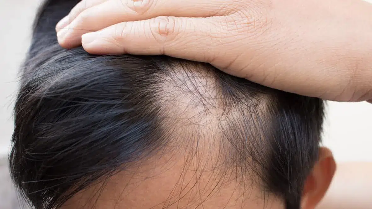 4 Benefits of Hair Restoration That may Surprise You