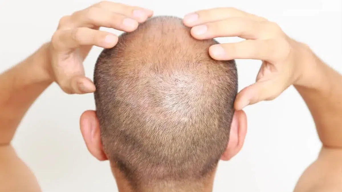 Can a Balding Man Regrow Hair?