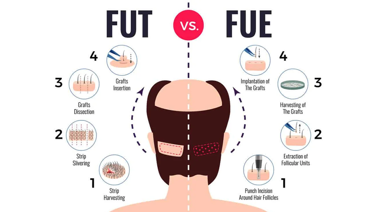 Differences between FUE and FUT