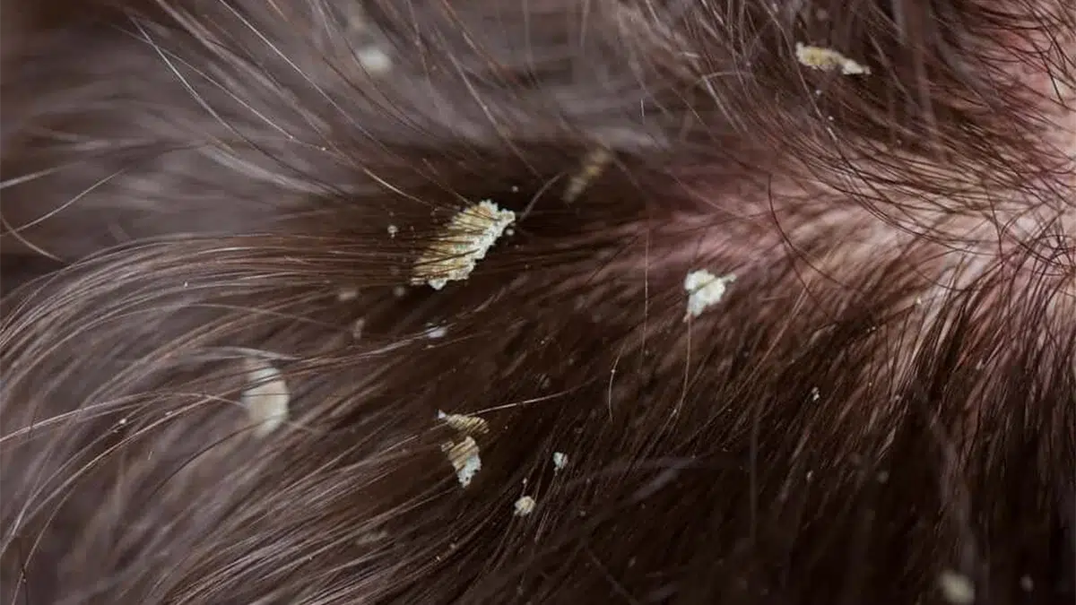 Does Dandruff Cause Hair Loss? Debunking the Myth with Science