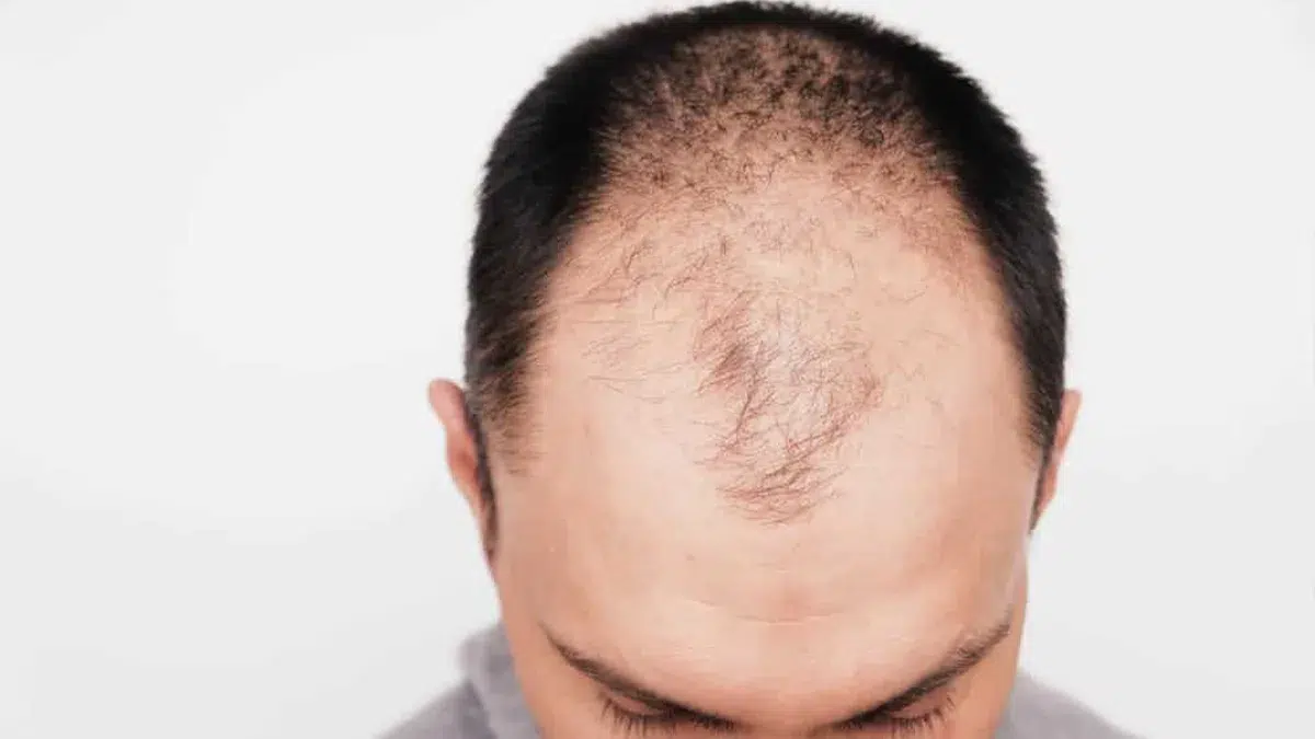 Exploring The Balding Gene: Myths, Facts, And Future Possibilities
