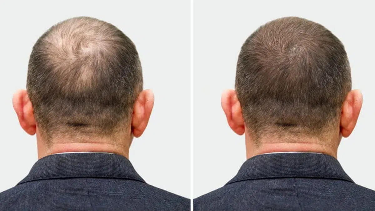 How Hair Restoration Treatments in Raleigh Can Enhance Natural Beauty