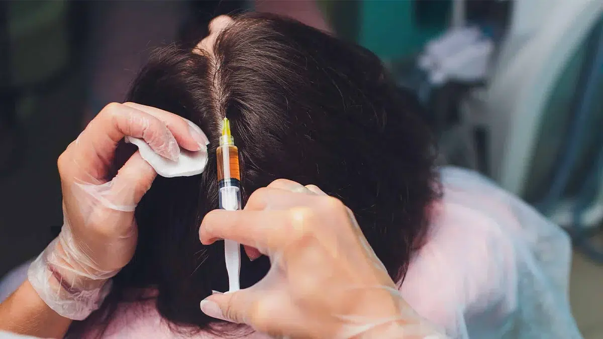 Growth Factor Hair Restoration: Is It the Right Treatment for You?