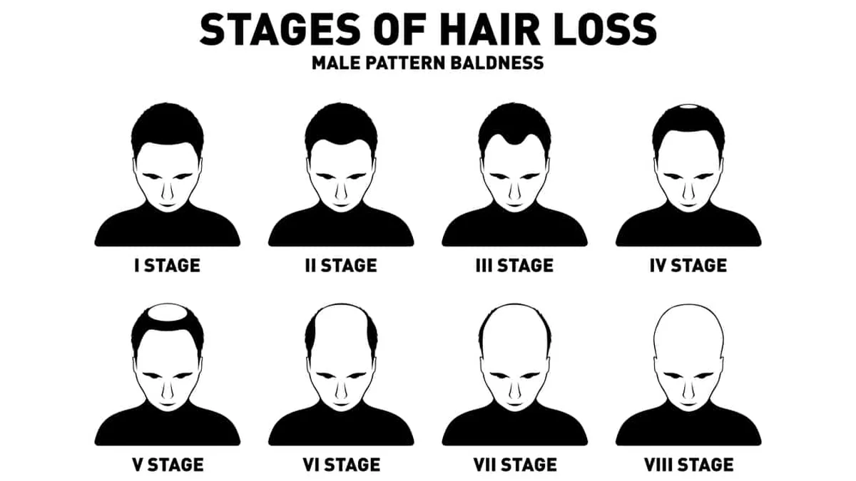 Common Stages Observed In Pattern Baldness