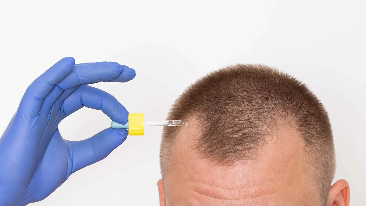 The Future of Hair Restoration: Exploring Cutting-Edge Techniques