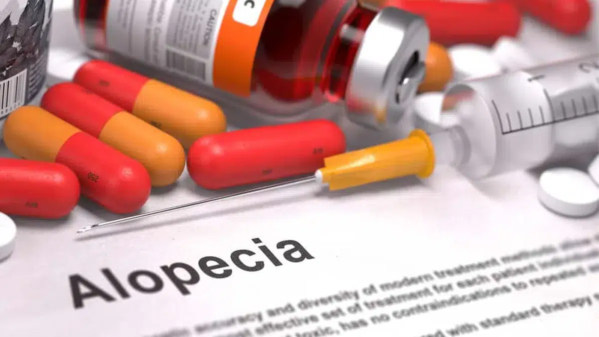 Understanding Alopecia: Causes, Types, and Treatment Options