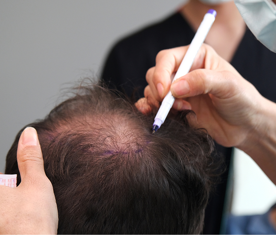 What Can FUE Hair Restoration Treat