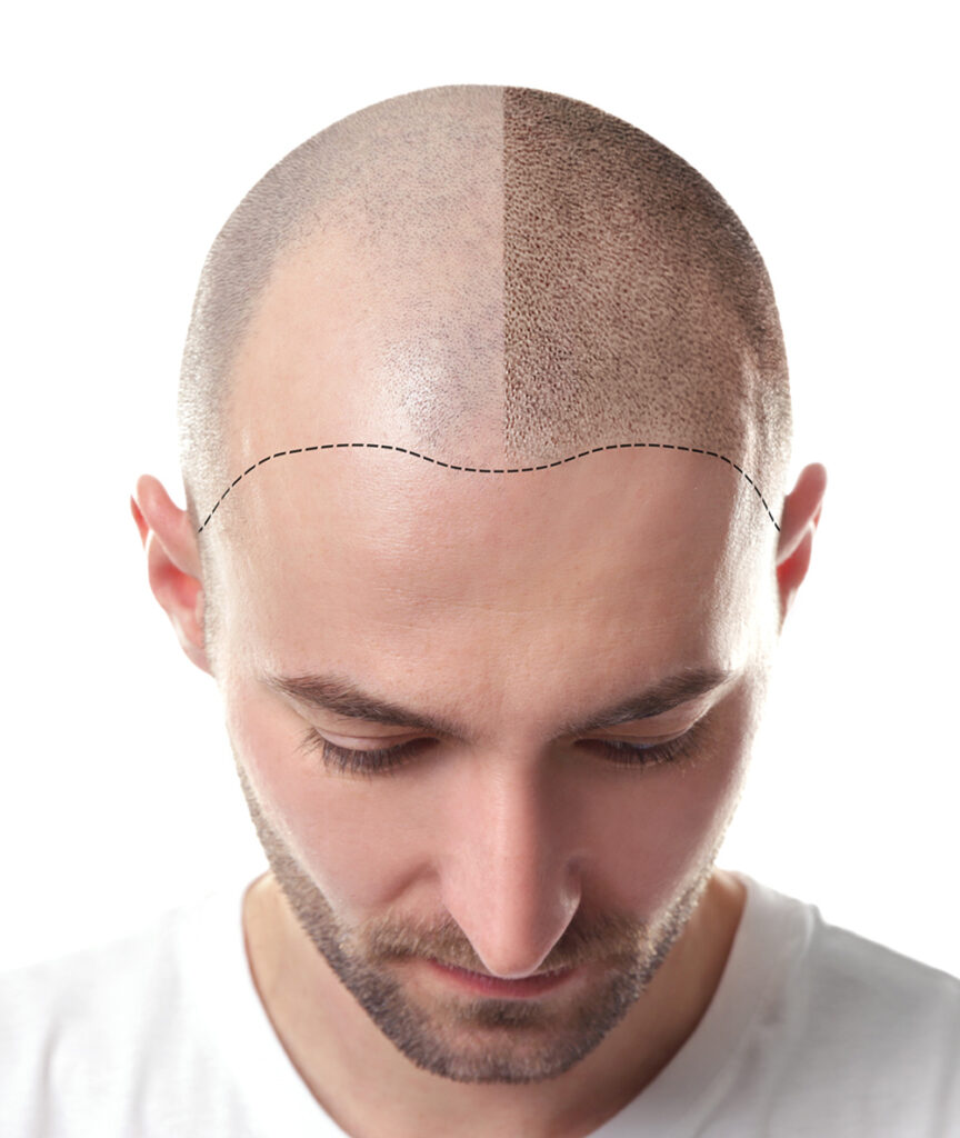 strip hair transplant method