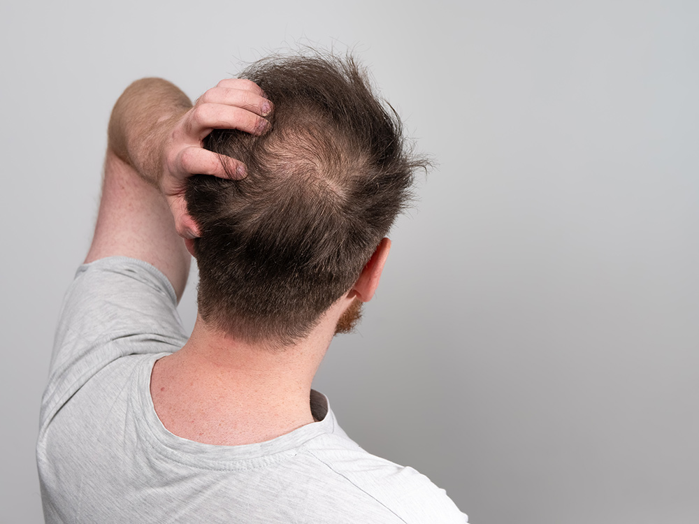 How To Tell If Hair Loss Is Stress Related | Anxiety & Hair Falling Out | How To Restore Hair Growth | Hair Growth Clinic Raleigh, NC.