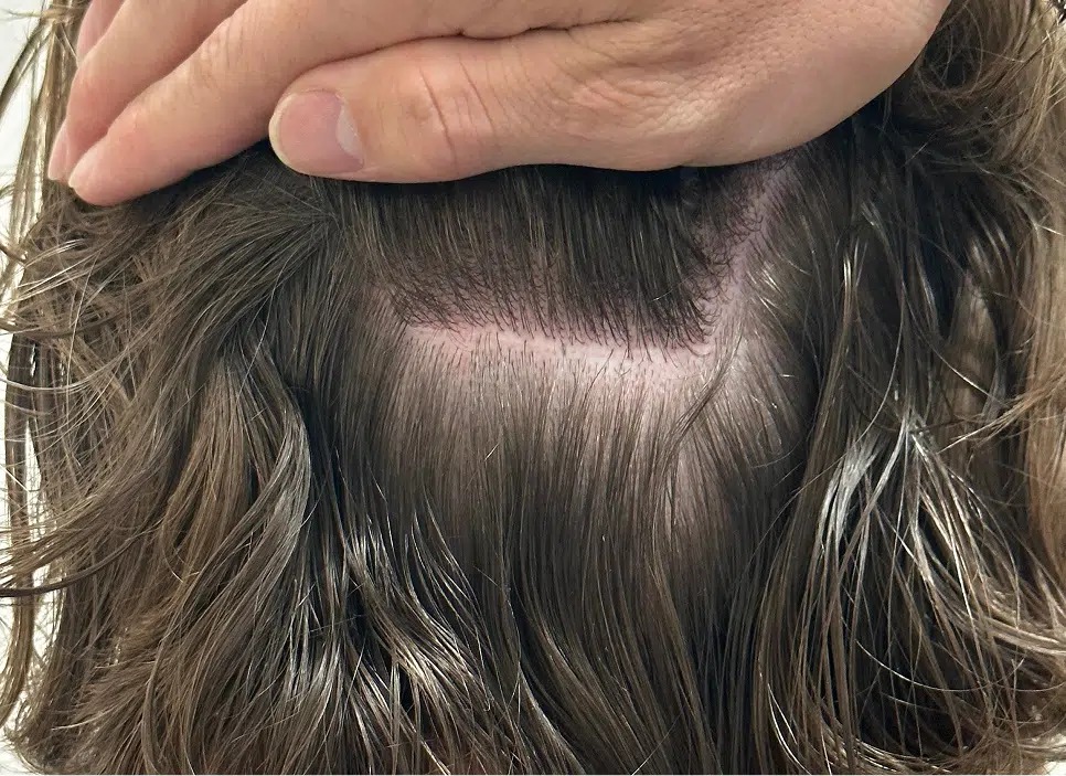 Medical Hair Loss Treatments | Surgical Hair Transplantation | Hair Growth Treatment For Men & Women | Best Hair Clinic In Raleigh, North Carolina | Anti Aging & Functional Medicine