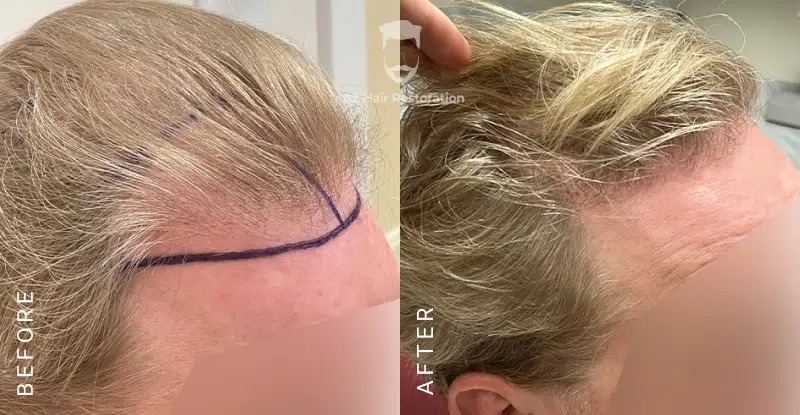 Hair Transplant Surgery Aftercare & Post Op Instructions | Hair Transplantation For Men & Women | Recovery Advice & Timeline For Hair Growth | best Hair Loss Clinic Raleigh, NC | Hair Transplant Surgeon | Anti Aging & Functional Medicine