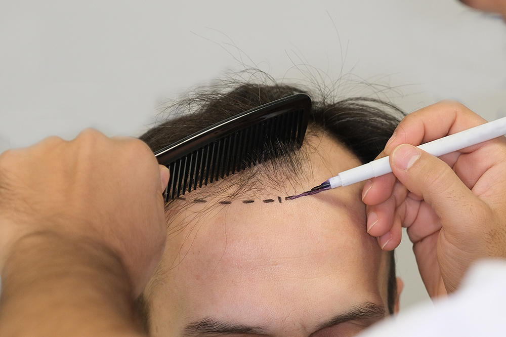 How To Treat Receding Hairline | Best Hair Growth Treatments | Hair Transplant | Hair Loss Clinic | Anti Aging & Functional Medicine Rayleigh, North Carolina