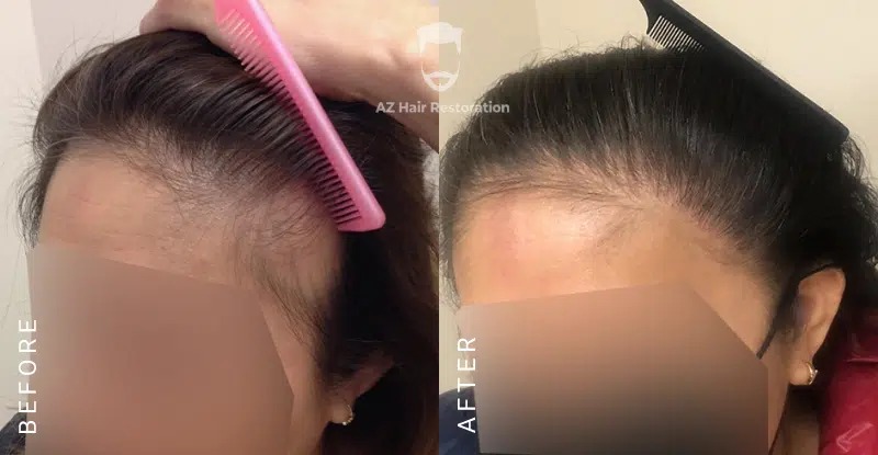 How To Treat Postpartum Hair Loss | Hair Loss In Women | Hormonal Hair Loss | Hair Loss Clinic Rayleigh, North Carolina | Anti Aging & Functional Medicine