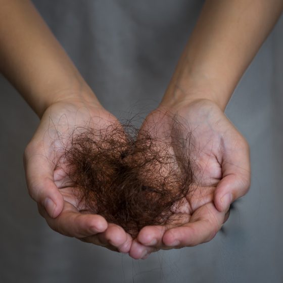 Does Diabetes Cause Hair Loss | Medication | Hormones | Immune System | Medical Hair Regrowth | Hair Loss Clinic | Anti Aging & Functional Medicine Raleigh North Carolina